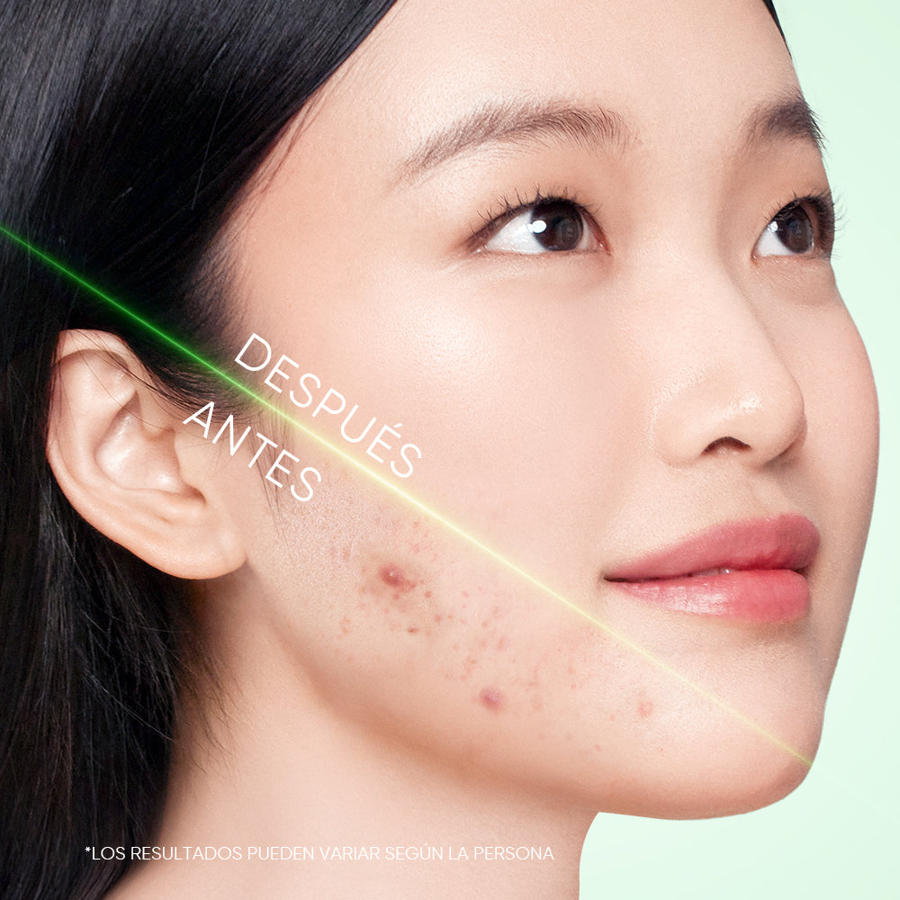 Limpiador en gel para acné con 3X de ácidos